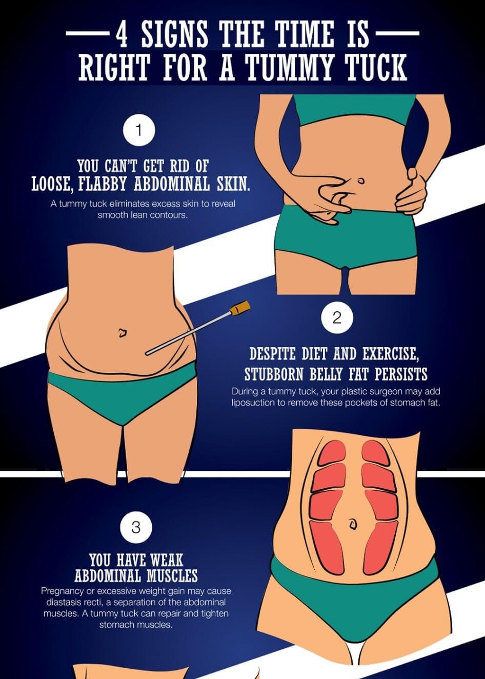 Tummy tuck